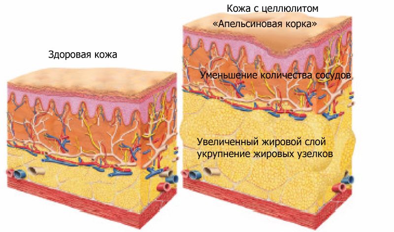 Отличия здоровой кожи от кожи с целлюлитом Отличия здоровой кожи от кожи с целлюлитом